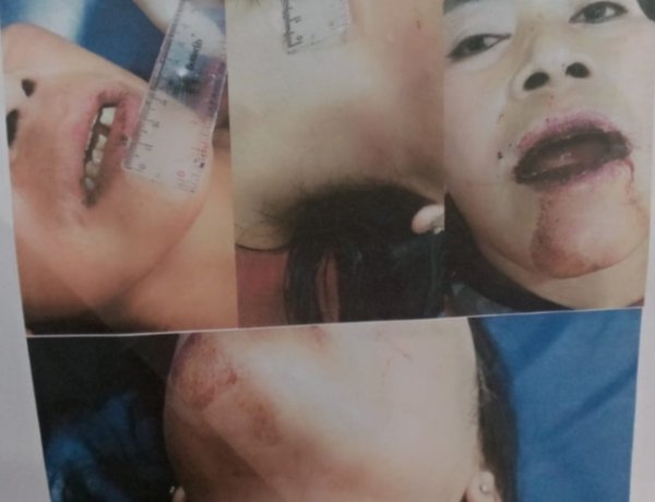 Miriiis..!! Kasus Korban Penganiyan Mariyam Warga Cilaban Bulan, Belum Ada Kepastian Hukum