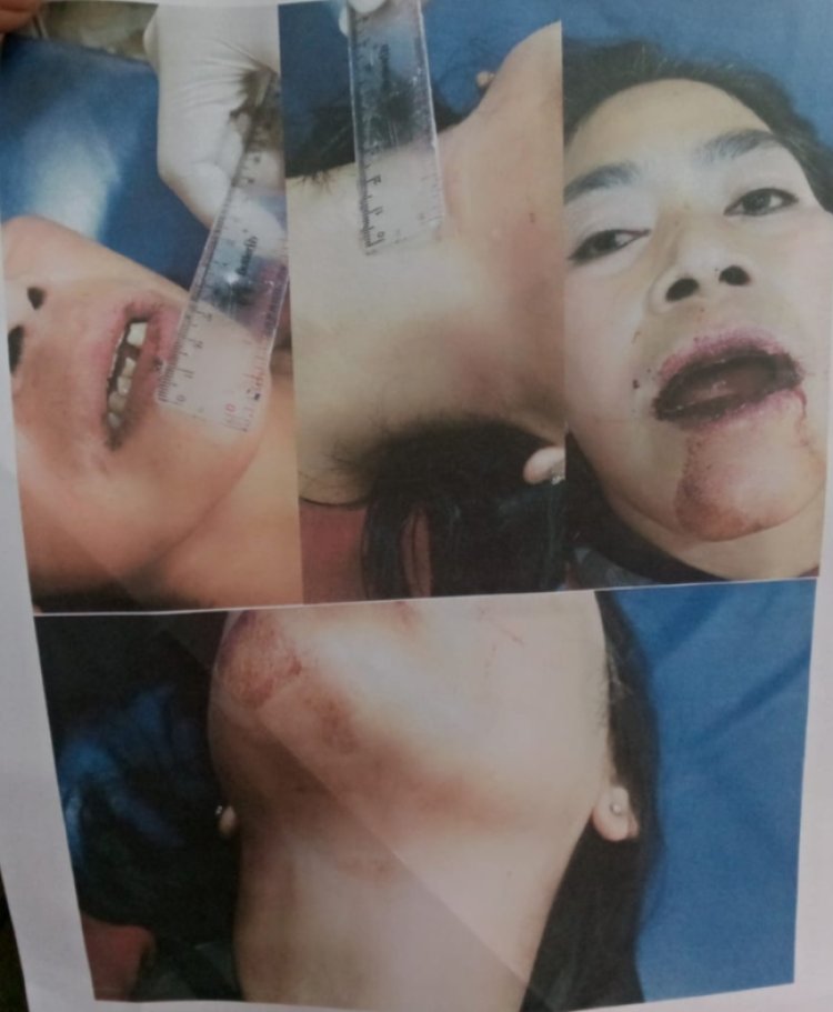 Miriiis..!! Kasus Korban Penganiyan Mariyam Warga Cilaban Bulan, Belum Ada Kepastian Hukum